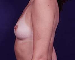 Breast Augmentation Before & After Patient #818