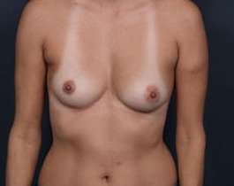 Breast Augmentation Before & After Patient #832
