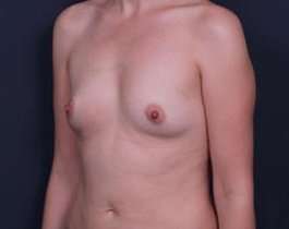 Breast Augmentation Before & After Patient #853