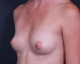 Breast Augmentation Before & After Patient #861