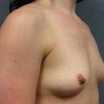 Breast Augmentation Before & After Patient #878