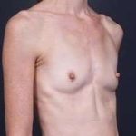 Breast Augmentation Before & After Patient #885