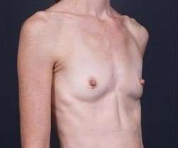 Breast Augmentation Before & After Patient #885