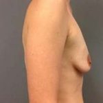 Breast Augmentation Before & After Patient #899