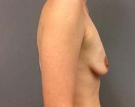 Breast Augmentation Before & After Patient #899