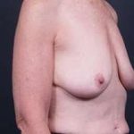 Breast Mastopexy Before & After Patient #183