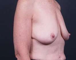 Breast Mastopexy Before & After Patient #183
