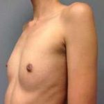 Breast Augmentation Before & After Patient #918