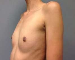 Breast Augmentation Before & After Patient #918