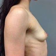 Breast Augmentation Before & After Patient #932