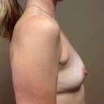 Breast Augmentation Before & After Patient #1022