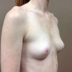 Breast Augmentation Before & After Patient #1070