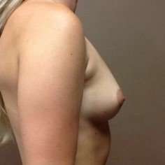 Breast Augmentation Before & After Patient #1142