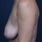 Breast Mastopexy Before & After Patient #197