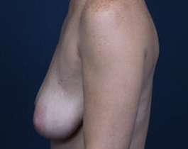 Breast Mastopexy Before & After Patient #197