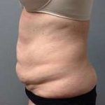 Tummy Tuck Before & After Patient #1263