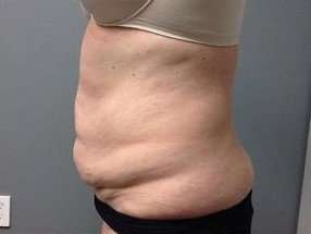Tummy Tuck Before & After Patient #1263