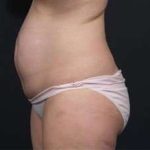 Tummy Tuck Before & After Patient #1270