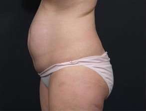 Tummy Tuck Before & After Patient #1270