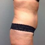 Tummy Tuck Before & After Patient #1277