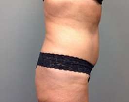 Tummy Tuck Before & After Patient #1277