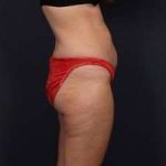 Tummy Tuck Before & After Patient #1284
