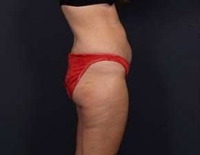 Tummy Tuck Before & After Patient #1284