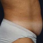 Tummy Tuck Before & After Patient #1296