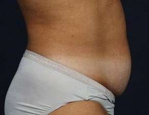 Tummy Tuck Before & After Patient #1296