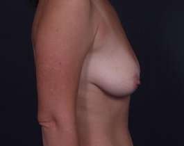 Breast Mastopexy Before & After Patient #209