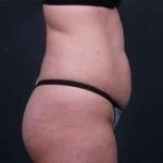 Tummy Tuck Before & After Patient #1303