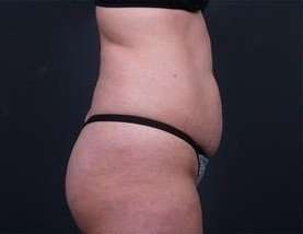 Tummy Tuck Before & After Patient #1303