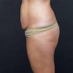 Tummy Tuck Before & After Patient #1310