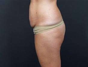Tummy Tuck Before & After Patient #1310