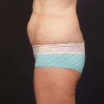 Tummy Tuck Before & After Patient #1322