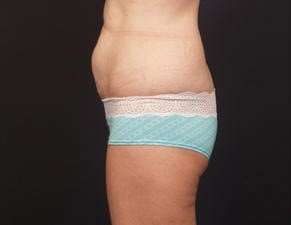 Tummy Tuck Before & After Patient #1322