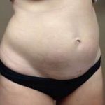 Tummy Tuck Before & After Patient #1349
