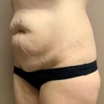 Tummy Tuck Before & After Patient #1371