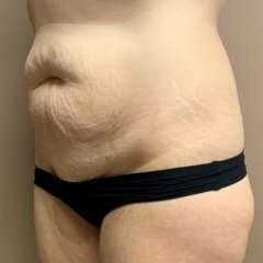 Tummy Tuck Before & After Patient #1371