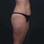 Tummy Tuck Before & After Patient #1378