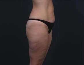 Tummy Tuck Before & After Patient #1378