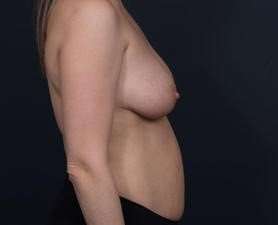 Mommy Makeover Before & After Patient #1435